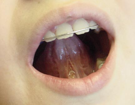 10 yr old lingual frenectomy immediate post op.jpg